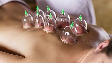 Cupping at Optimal Health in Beverly Hills, Los Angeles, California
